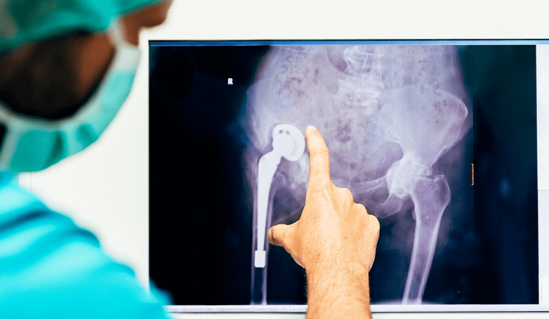 Can Your Orthopedic Doctor Treat Hip Dysplasia Without Surgery?