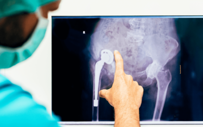 Can Your Orthopedic Doctor Treat Hip Dysplasia Without Surgery?